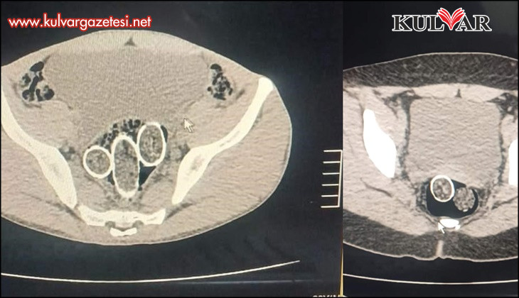 320 gram uyuşturucuyu mide ve rahme sakladılar